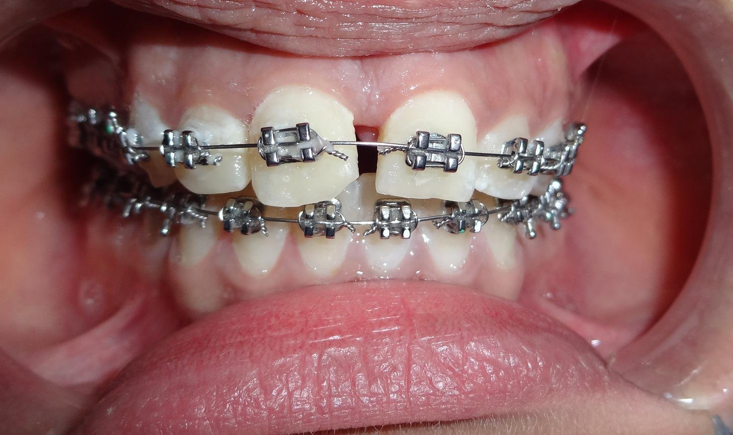 Orthodontic Brackets Treatment